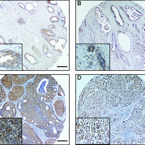 Srebp Induces Cell Proliferation And Progression Through Alterations