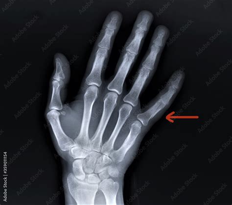 Radiography Of The Hand Bones With A Fracture Of The Proximal Phalanx