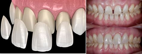 Porcelain Veneers Transform Your Smile Blog Smile In Minutes