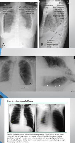 Pleural Effusion Flashcards Quizlet