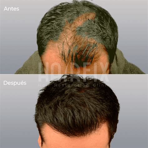 Clínica de Injerto Capilar en México HairFix