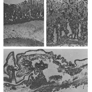 Hemorrhagic Ulceration Of The Mucosa Of Urinary Bladder With Severe