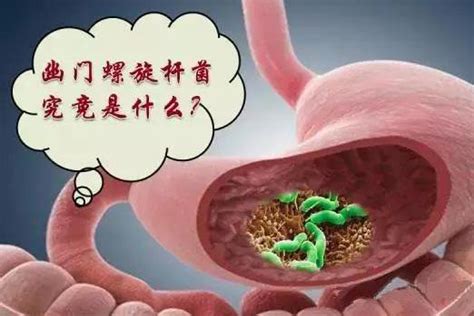 幽门螺杆菌阳性会得胃癌？你对“胃癌菌”了解多少？