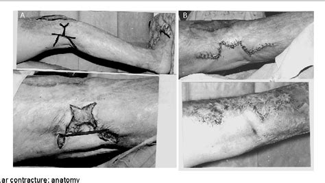 Figure 1 From Postburn Knee Flexions Contractures Anatomy And Methods Of Their Treatment