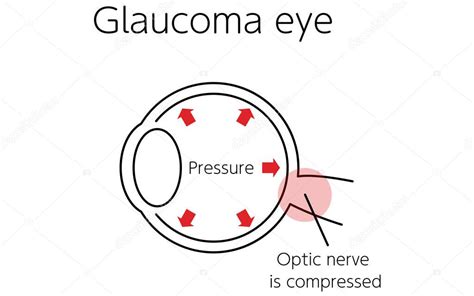 Ilustración De Cómo Funciona El Glaucoma Ojo De Glaucoma Ilustración