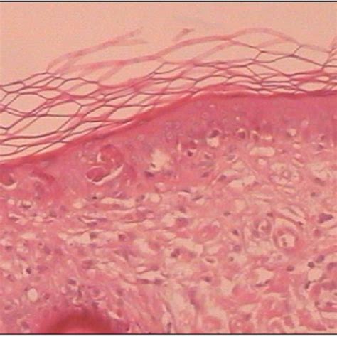 Skin Biopsy Stained With Hematoxylin Eosin H E At 20 Showing Basal