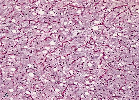 Pathology Outlines Myxoid Liposarcoma