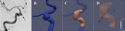 Frontiers Tortuosity Of Parent Artery Predicts In Stent Stenosis