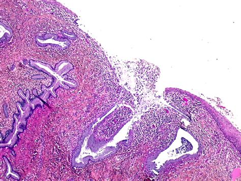 Cervicitis Pictures