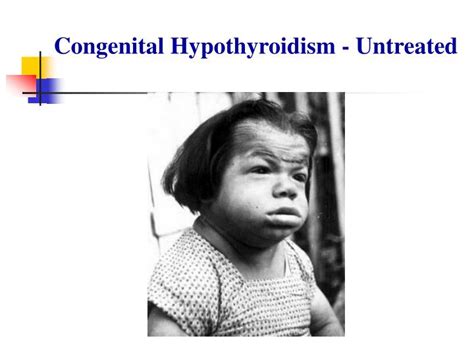 Ppt Congenital Hypothyroidism Powerpoint Presentation Id 6361450