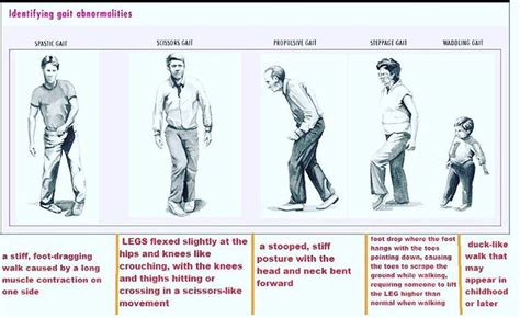 Gait Abnormalities Gait Abnormality Is A