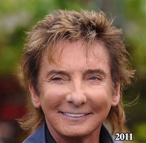 Barry Manilow Botox Overdose Latest Plastic Surgery Gossip And