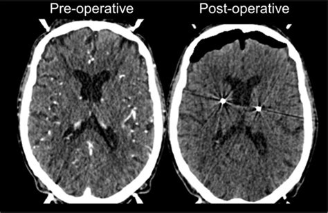 Exemplary Case Of High Volume Pneumocephalus In Year Old Patient