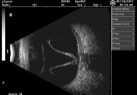 Odu Ophthalmic A B Ultrasound Scanner