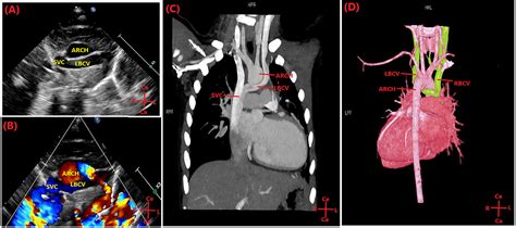 An Unusual Case Of Prenatal Diagnosis Of Isolated Subaortic Left