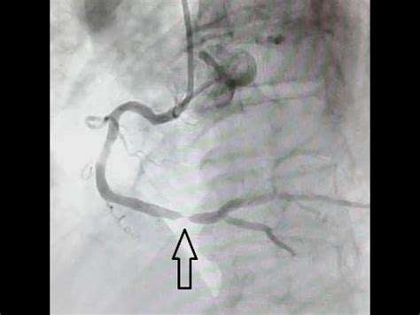 Entenda Como Feita A Angiografia E A Angioplastia