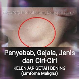 PENYEBAB GEJALA JENIS BESERTA CIRI CIRINYA KANKER KELENJAR GETAH