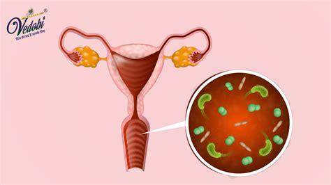 Vedobi Know All About Chlamydia Symptoms Causes And Treatment