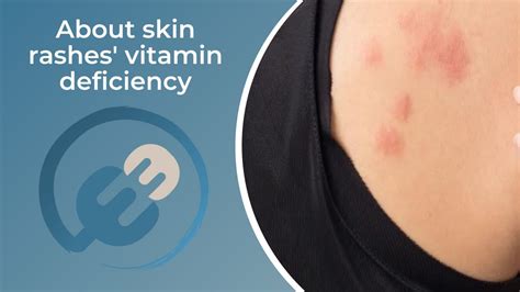 Vitamin Deficiency Causing Rash At Steven Curl Blog