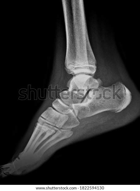 Xray Normal Human Foot Lateral View Stock Photo Shutterstock