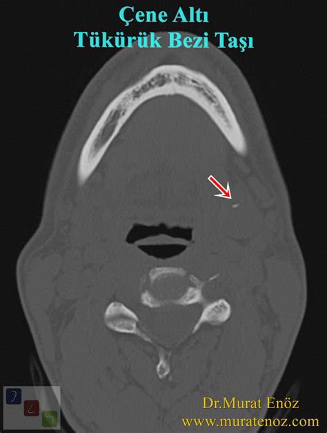 Salivary Gland Stones