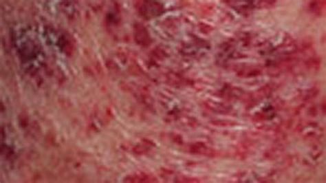 Anemia Rash: Causes, Pictures, and Treatment