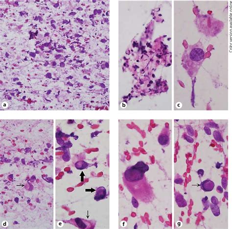 Figure From Squash Cytology Of A Dural Based High Grade