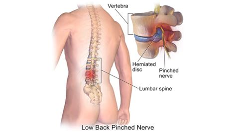 Lower Back Pain:Symptoms, Causes, Treatment By Back Braces