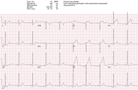 Hyperacute T waves and Occlusion MI | ECG Cases| Emergency Medicine Cases