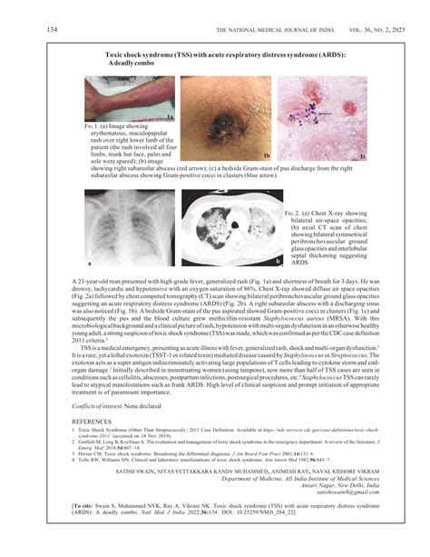 Pdf Toxic Shock Syndrome Tss With Acute Respiratory Distress