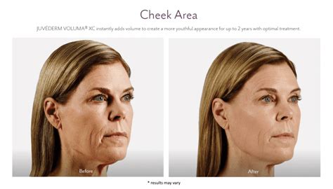 Juvederm Before And After Pictures Juvederm Westport Ct