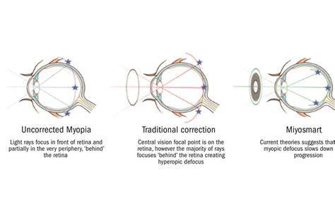 Lens File Making The Miyosmart Move