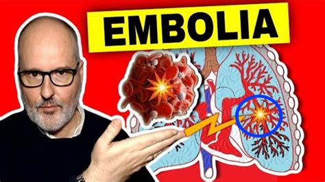 EMBOLIA PULMONAR Síntomas Causas Prevención y Soluciones YouTube