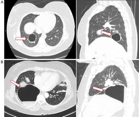 Intraparenchymal Bronchogenic Cyst A Axial And Sagittal Images Of A