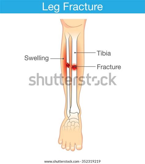 Diagram Leg Have Bone Fracture This Stock Vector (Royalty Free) 352319219