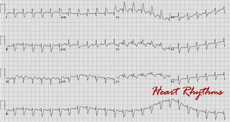 Typical atrial flutter and ecg - ukrainesmash