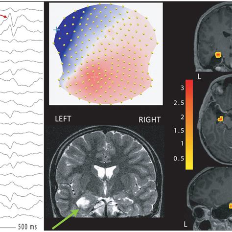 Eeg Fmri And Esi In A Patient With Right Posterior Quadrant Epilepsy