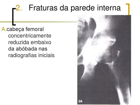 Luxa Es Do Quadril E Fraturas Da Cabe A Do F Mur Ppt Carregar