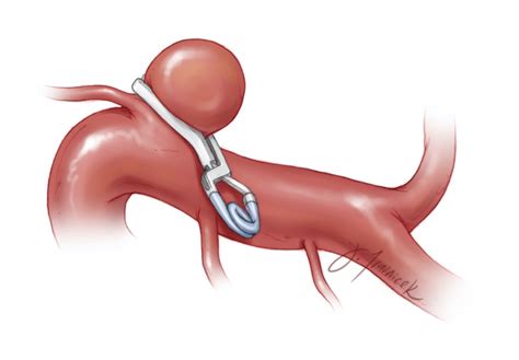 Aneurysm Surgery Expert Surgeon Aaron Cohen Gadol Md Aaron Cohen Gadol Md