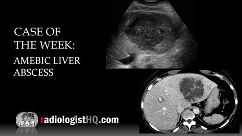 Entamoeba Histolytica Liver Abscess