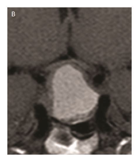 Coronal T1-weighted MRI images in two patients with pituitary apoplexy ...