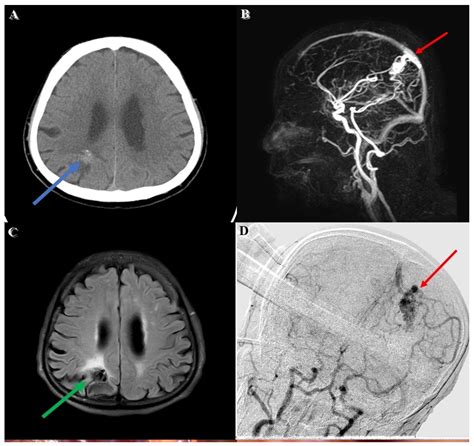 Arteriovenous Malformation Mri