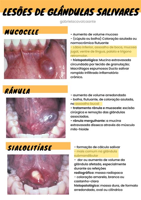 Les Es De Gl Ndulas Salivares Mucocele R Nula Sialolit Ase Les Es De