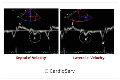 5 Steps to Identify Diastolic Dysfunction in Echo Cardioserv