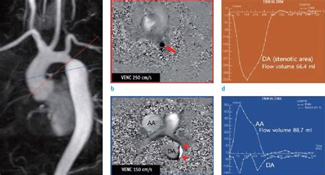 Case Of 31 Year Old Man With Coarctation Of Aorta A Download Scientific Diagram