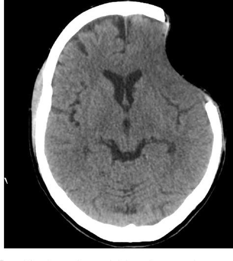 Figure 1 From Comprehensive Cognitive And Cerebral Hemodynamic Evaluation After Cranioplasty