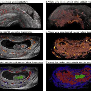 Three Dimensional Power Doppler Ultrasound Images Of Utero Placental