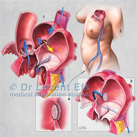 Patent Foramen Ovale Closure Dr Efes Medical Art Store Medical