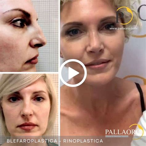 Rinoplastica Video Pallaoro Medical Laser