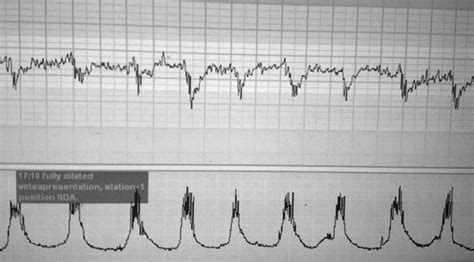 Early Decelerations Download Scientific Diagram